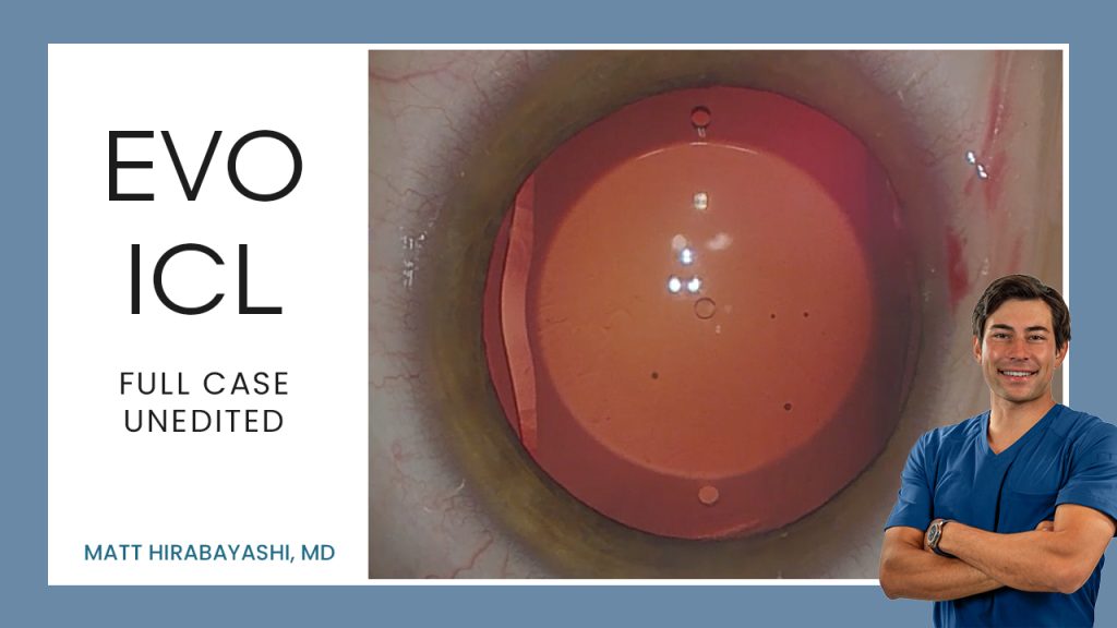 Perfect ICL Insertions — ICL Workshop