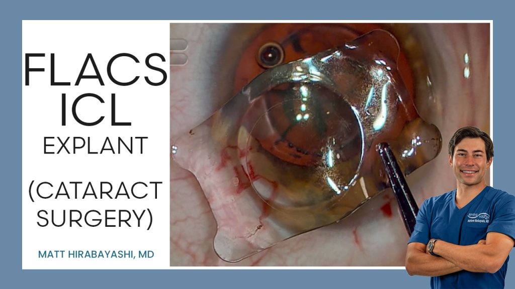 ICL Explant Before Cataract Surgery — ICL Workshop